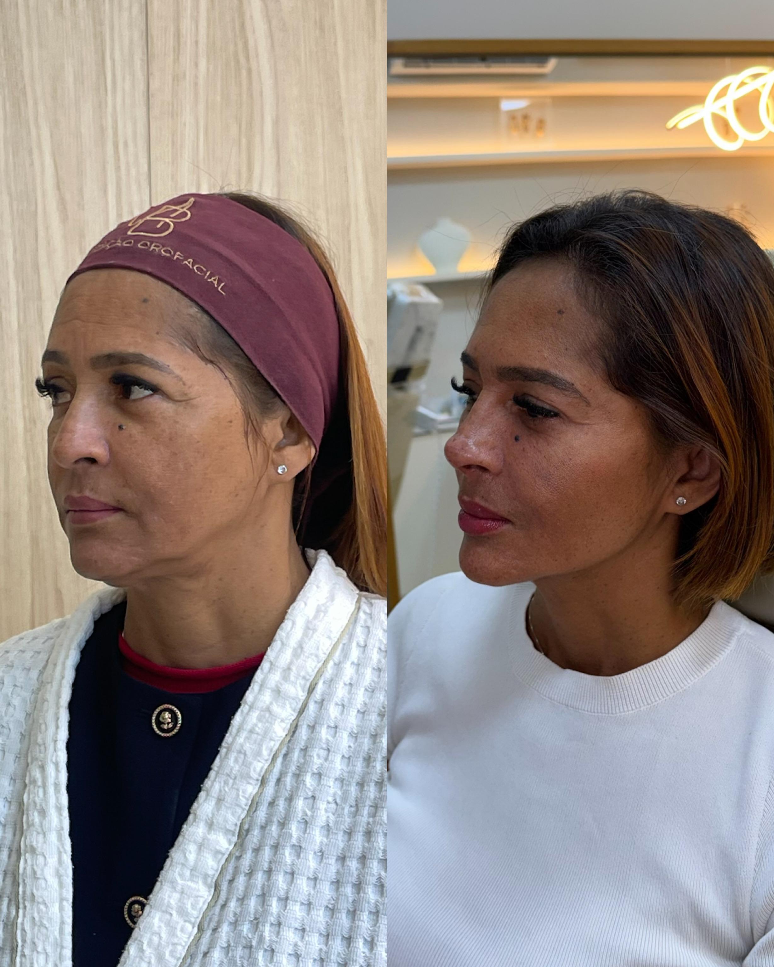 Cristian — Antes e Depois