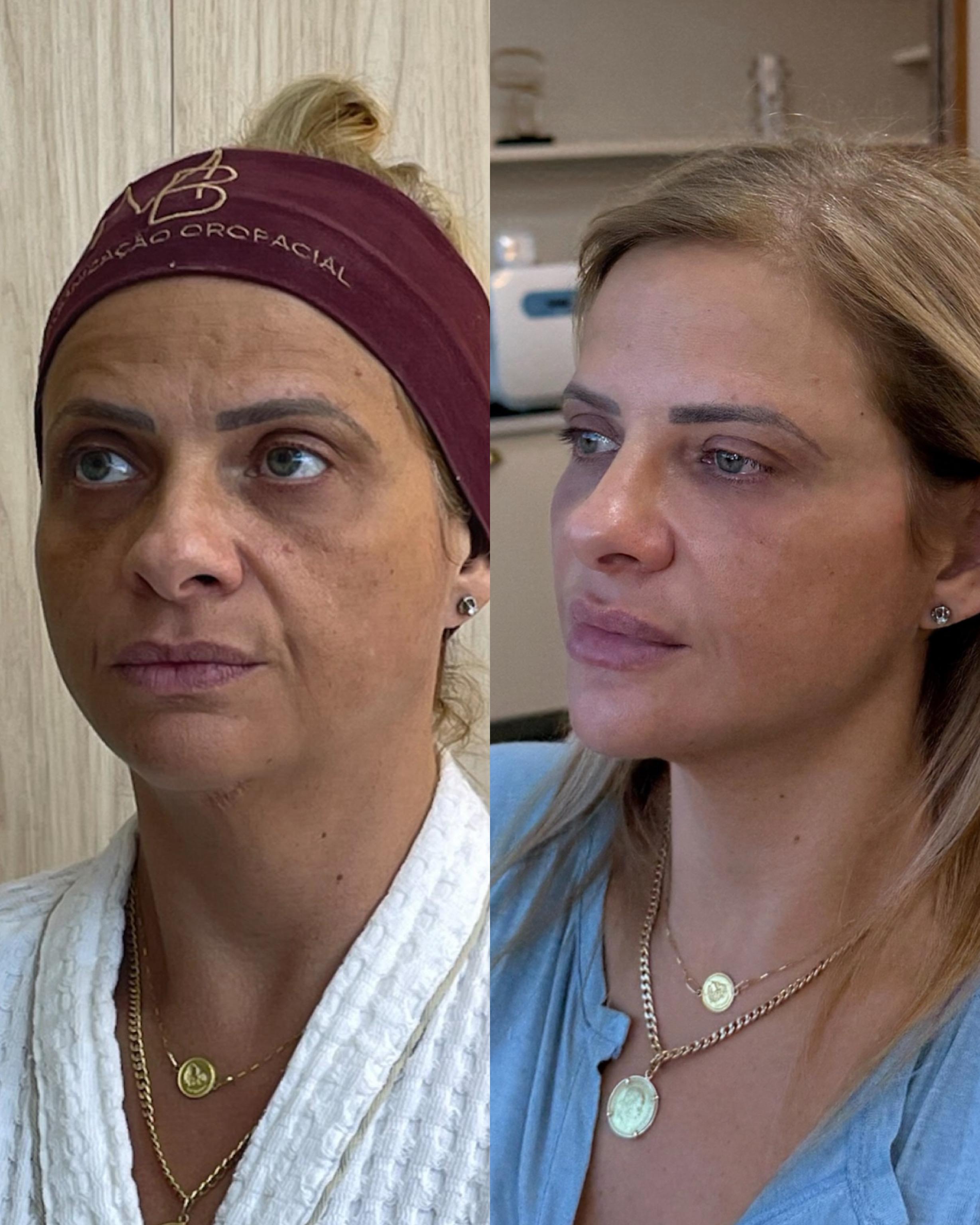 Dayse — Antes e Depois